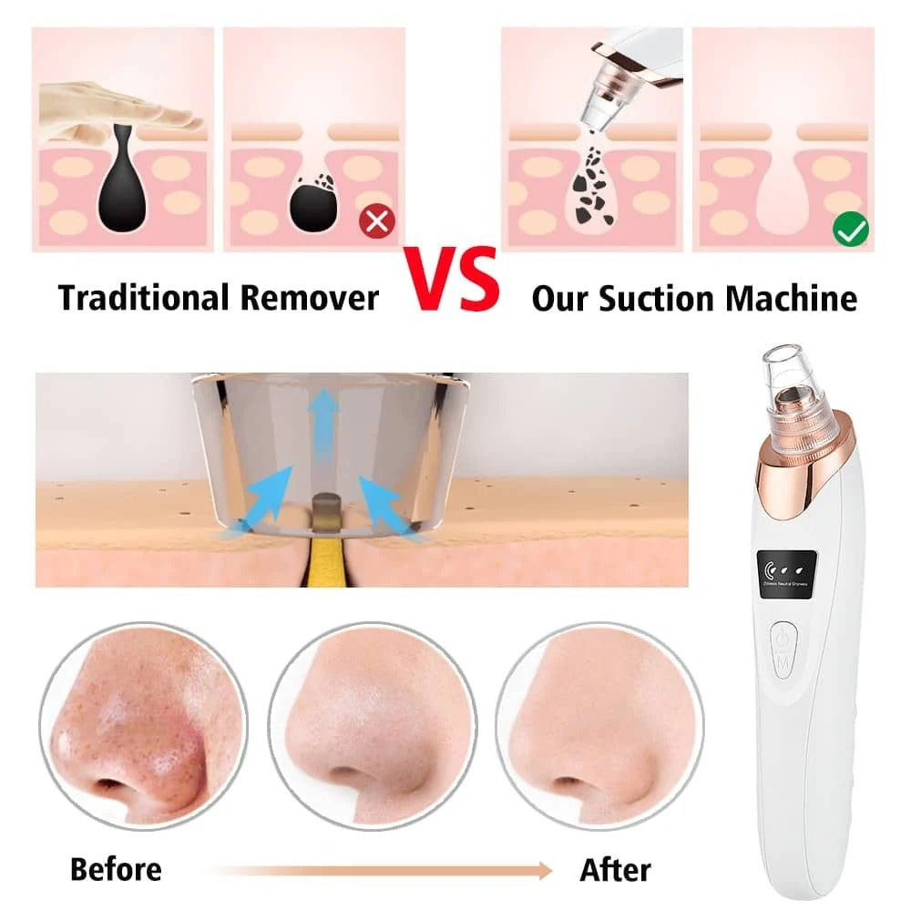 Electric Blackhead Remover – Pore Vacuum